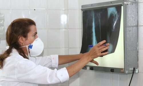 Campo Grande registra 156 casos de tuberculose; novas regras em unidades de saúde são adotadas